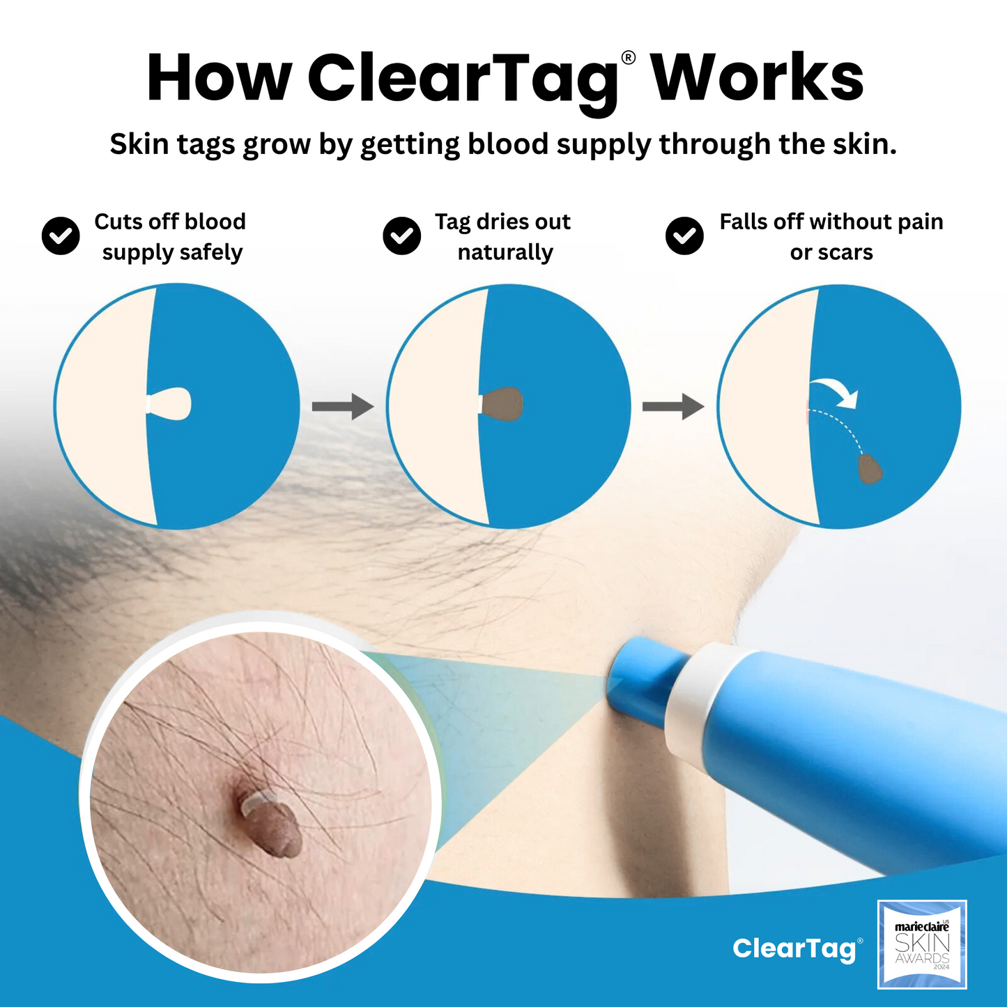How ClearTag skin tag remover works – safe band method step by step
