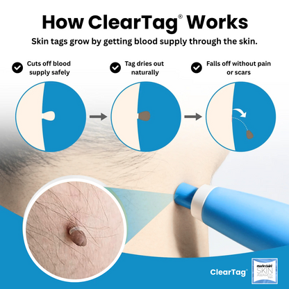 How ClearTag skin tag remover works – safe band method step by step