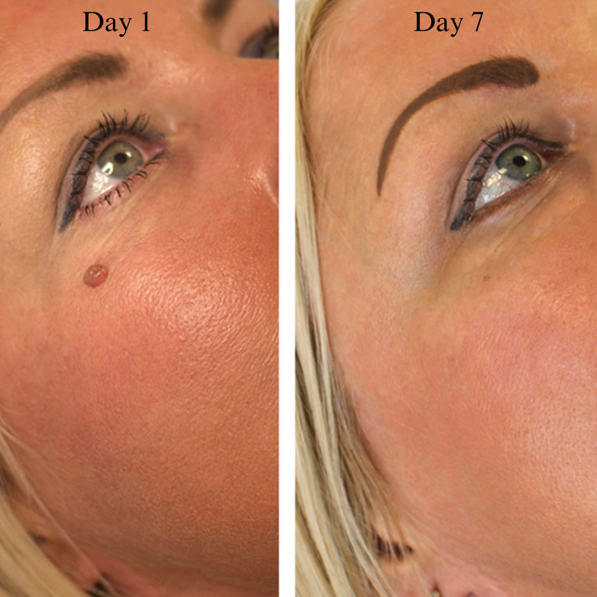 Skin tag removal before and after on face – ClearTag results day 1 vs day 7