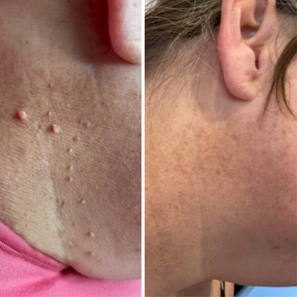Skin tag removal before and after on neck with ClearTag kit